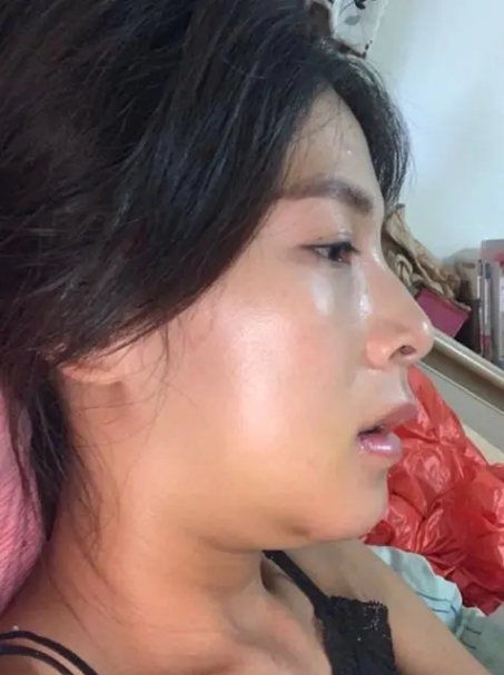 正顎手術案例分享,正顎術後恢復期,博恩妍