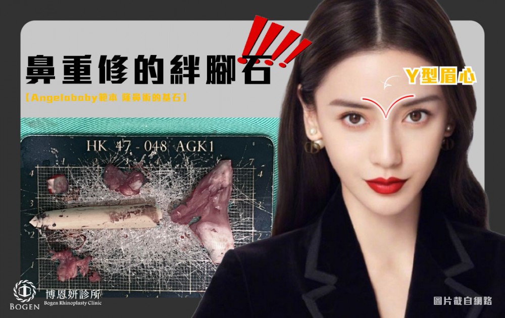 隆重修絆腳石y字眉心,y字眉心,鼻重修,博恩妍