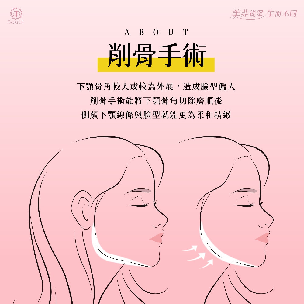 削骨手術讓下顎線條更精緻,削骨原理,削骨手術,削骨,博恩妍