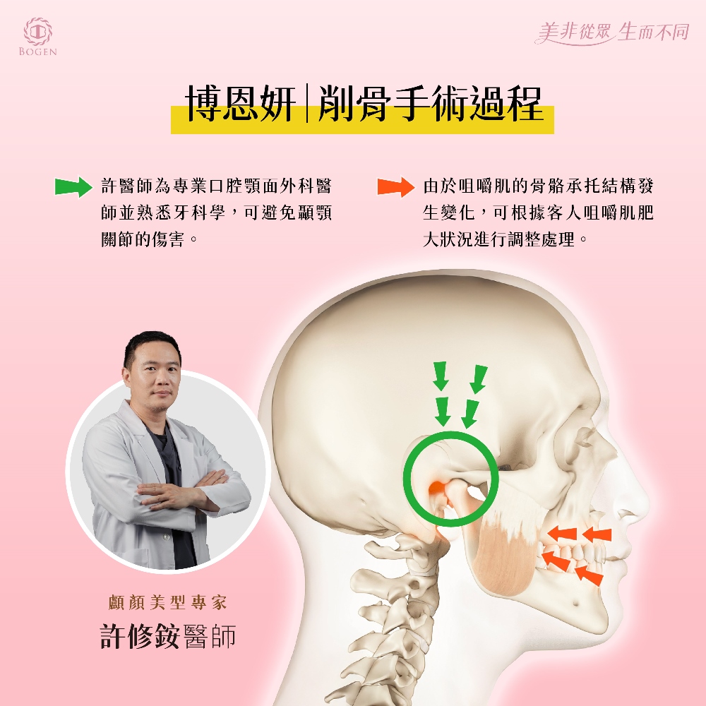 削骨手術避免傷害顳顎關節,削骨手術調整咀嚼肌肥大,削骨手術,削骨,博恩妍