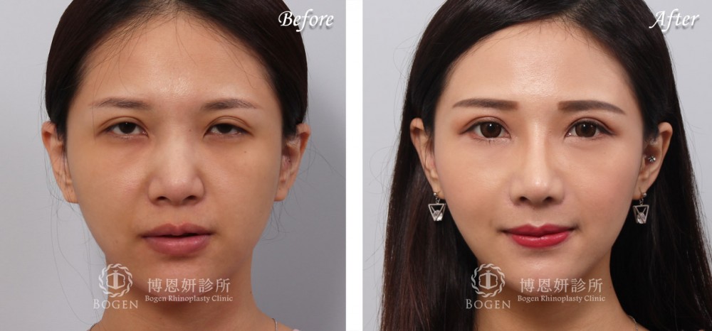 雙眼皮重修與提眼瞼肌矯正手術,提眼瞼肌矯正,博恩妍