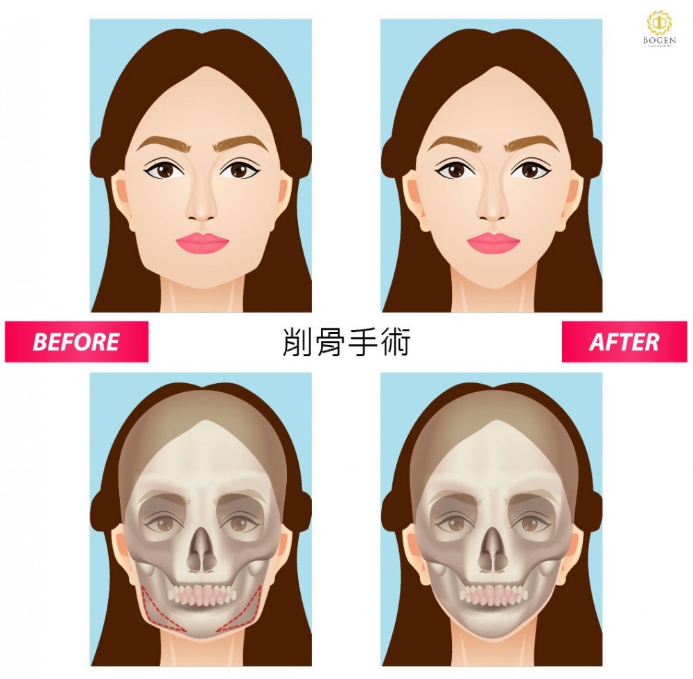 削骨,削骨手術原理,博恩妍