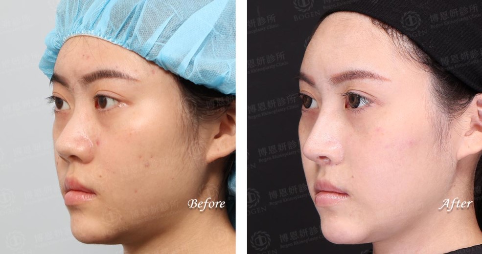 隆鼻可以維持多久,fitme完形美隆鼻案例,博恩妍