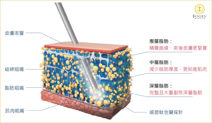 威塑抽脂原理,威塑抽脂,博恩妍