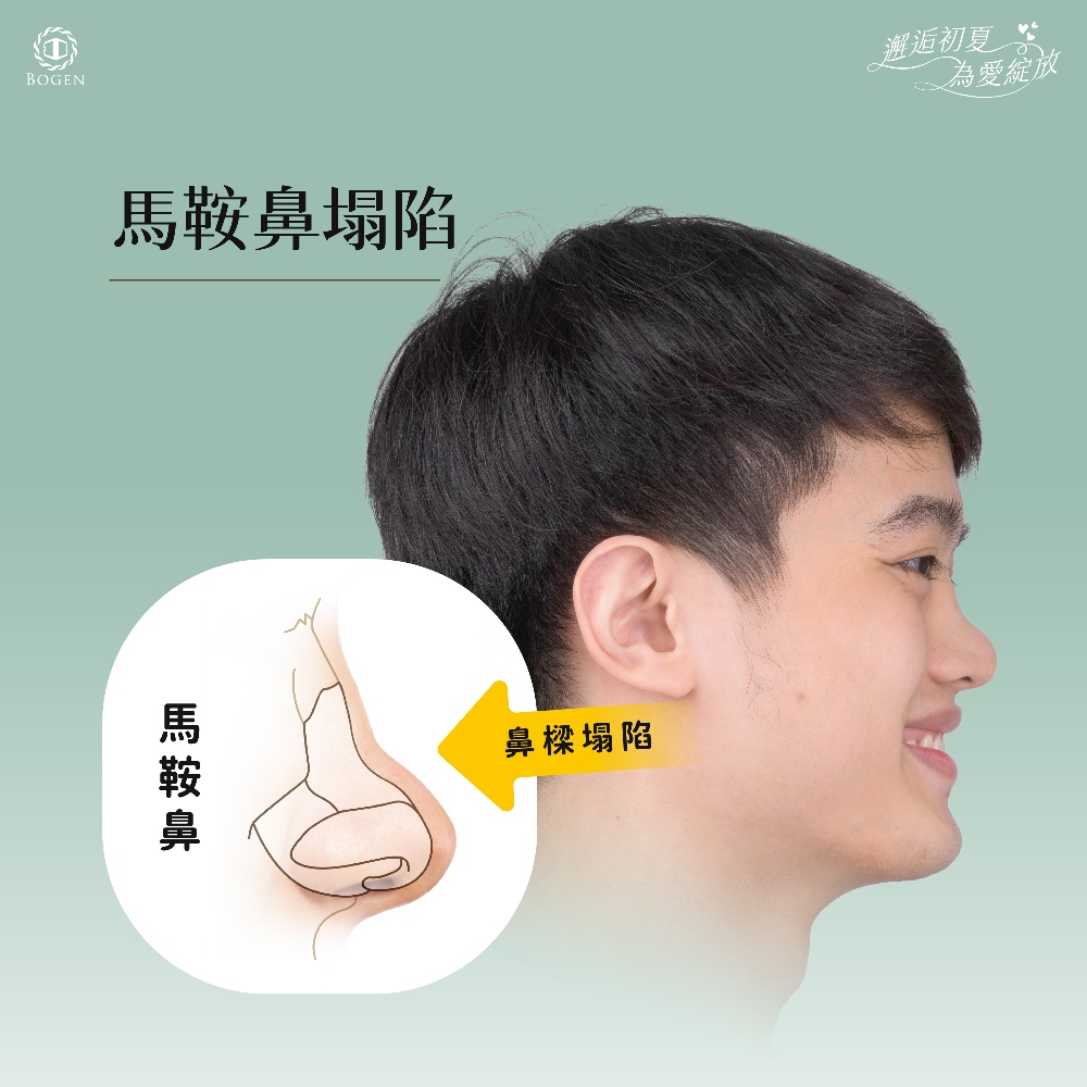 馬鞍鼻,馬鞍鼻塌陷,博恩妍