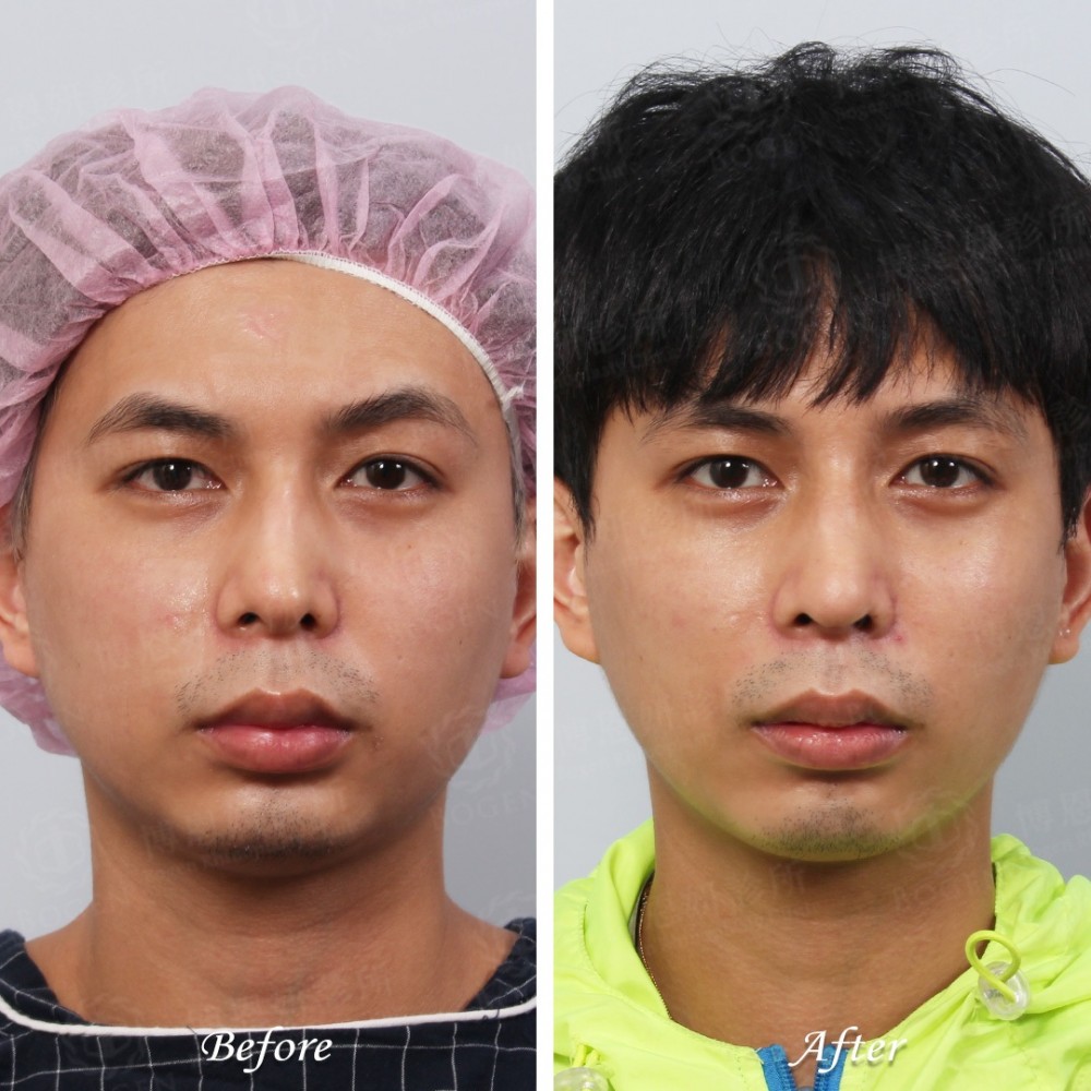 馬鞍鼻矯正,馬鞍鼻矯正案例,博恩妍