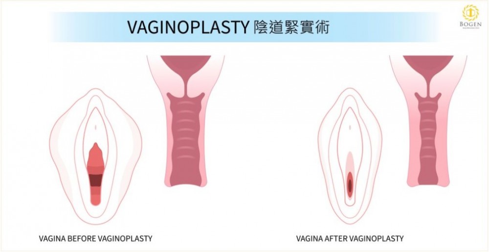 產後陰道鬆弛緊實術,陰道鬆弛,博恩妍