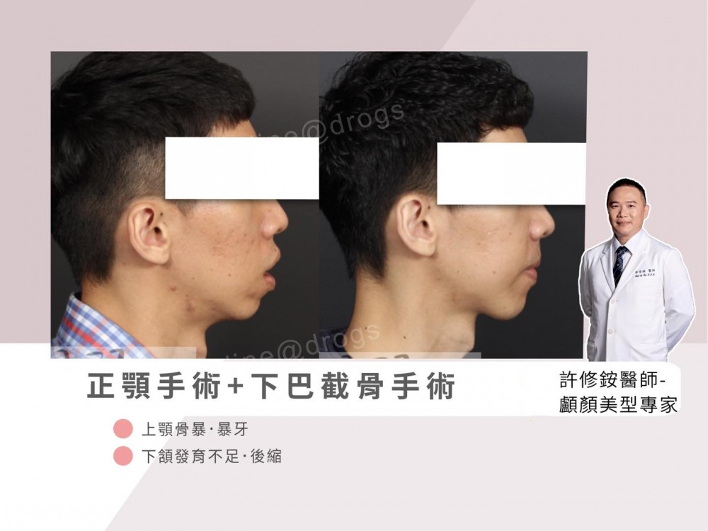 正顎手術改善暴牙,正顎手術推薦,博恩妍
