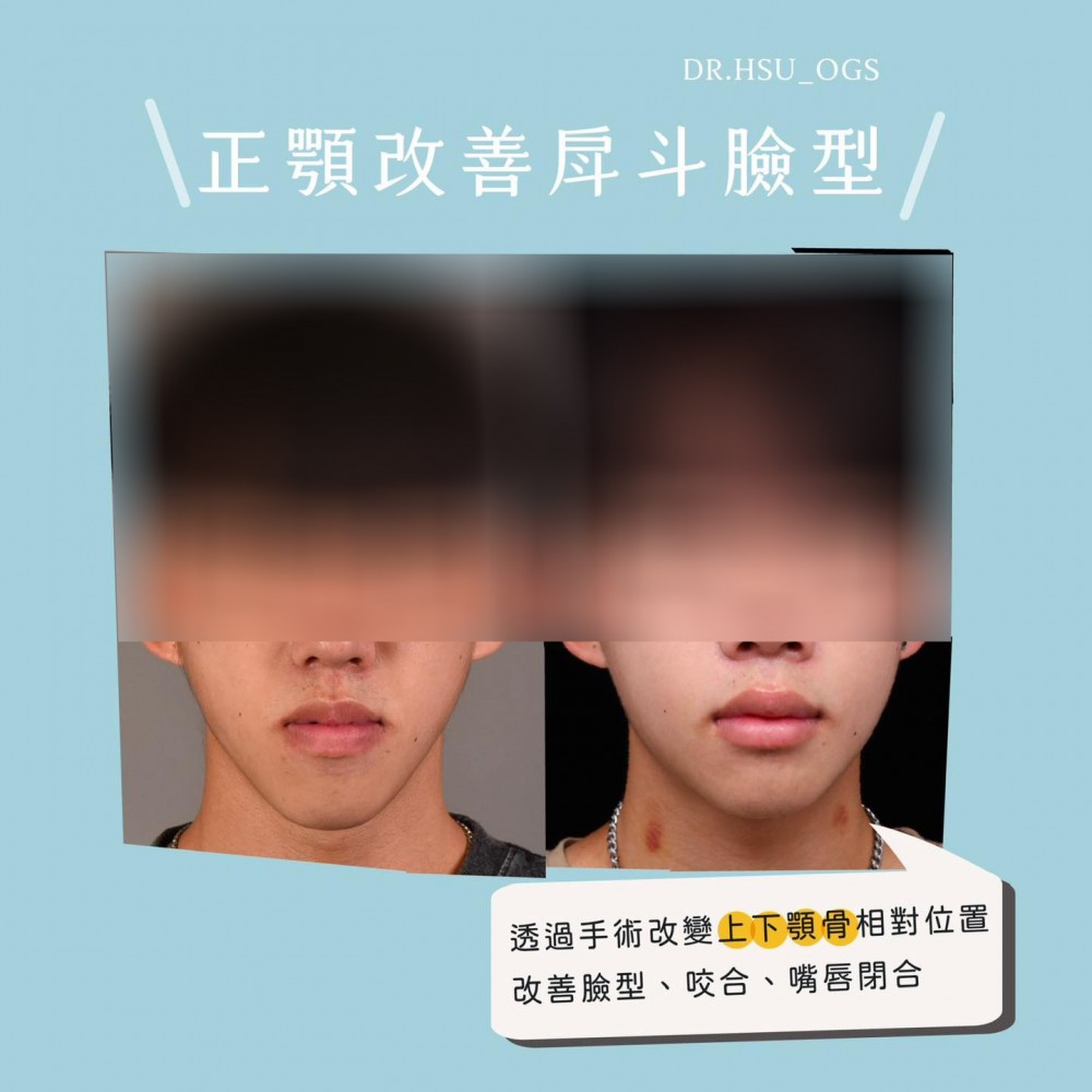正顎手術改善戽斗,正顎手術推薦,博恩妍