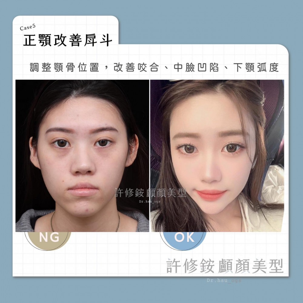 正顎手術改善戽斗,正顎手術推薦,博恩妍