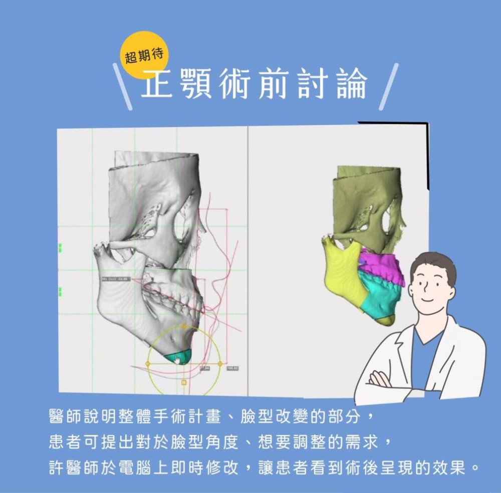 正顎手術術前諮詢準備,正顎手術推薦,博恩妍