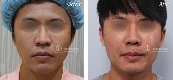 男性隆鼻+下巴手術案例,博恩妍