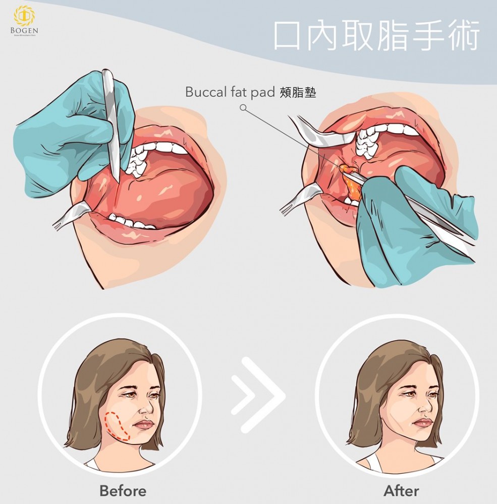 口內取脂,口內取脂手術原理,博恩妍