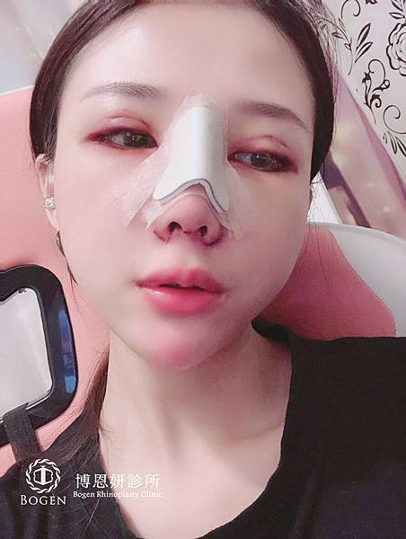 敲鼻骨術後鼻板固定,博恩妍