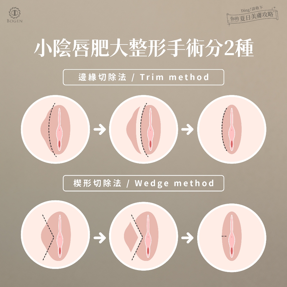 陰唇手術,陰唇美型手術,割陰唇,博恩妍