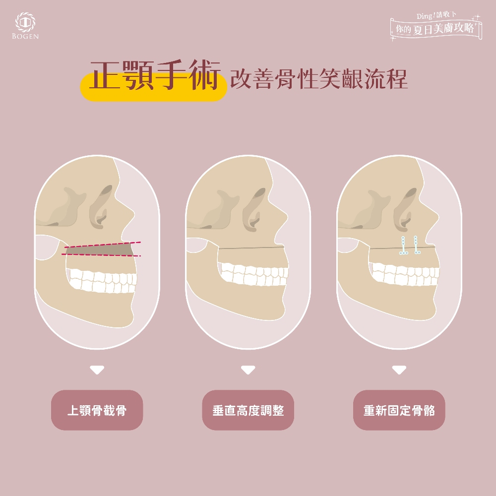 正顎矯正笑齦,笑齦矯正正顎手術流程,笑齦正顎,博恩妍