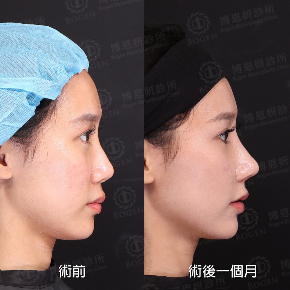 完形美隆鼻案例,完形美鼻重修案例,完形美,博恩妍