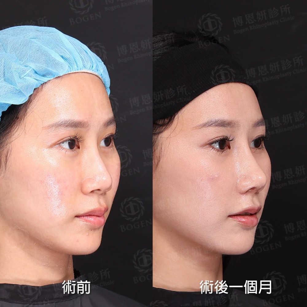 完形美隆鼻案例,完形美鼻重修案例,完形美,博恩妍