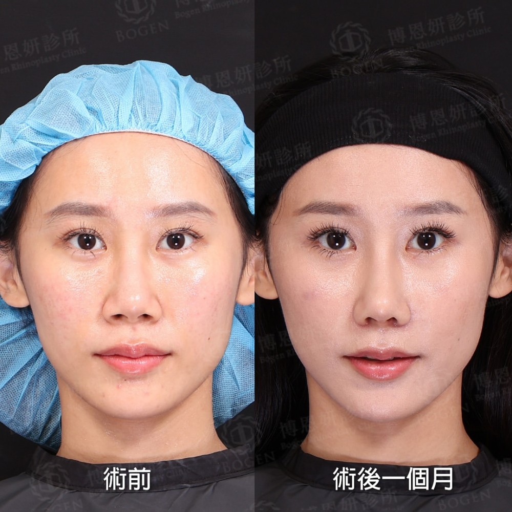 完形美隆鼻案例,完形美鼻重修案例,完形美,博恩妍