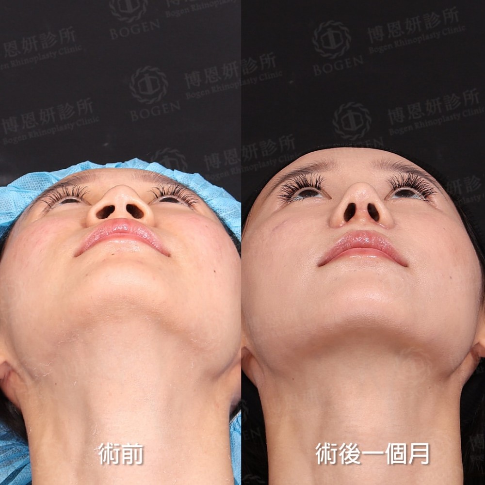完形美隆鼻案例,完形美鼻重修案例,完形美,博恩妍