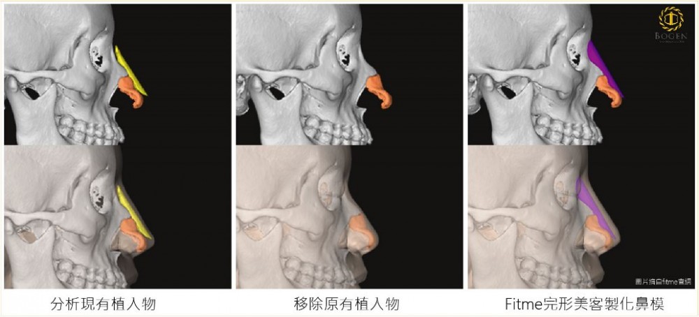 Fitme完形美在鼻重修手術的優勢,完形美,博恩妍