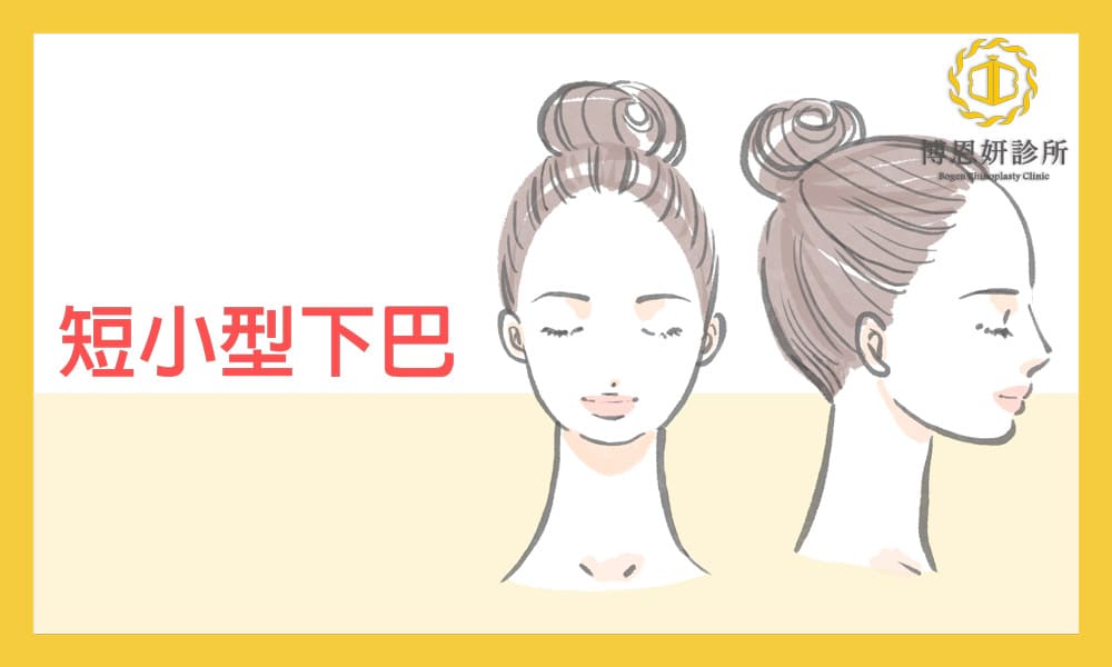 下巴型態,下巴短小,下巴手術,博恩妍