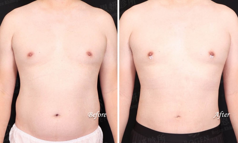 男性抽脂,男性腰腹抽脂,男性女乳抽脂,博恩妍