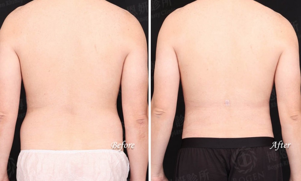 男性抽脂,男性腰腹抽脂,男性女乳抽脂,博恩妍