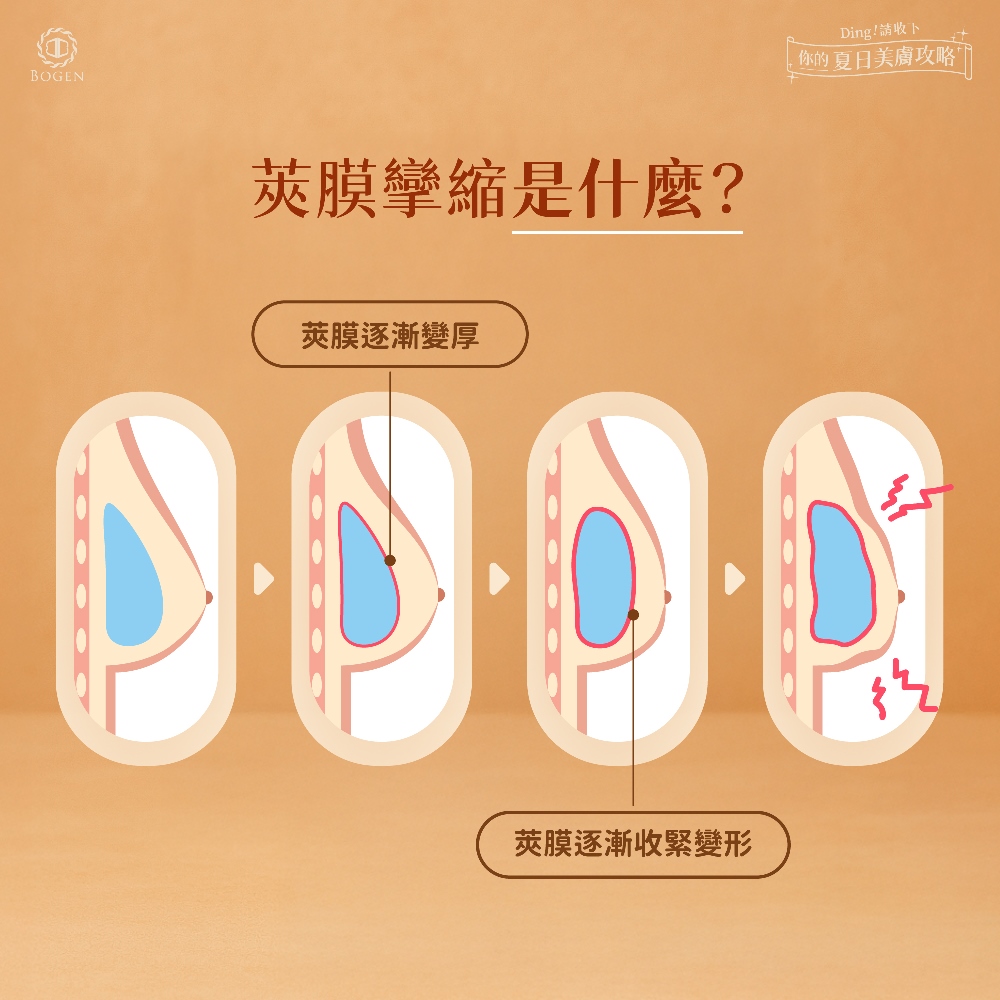 莢膜攣縮是什麼,莢膜攣縮,博恩妍