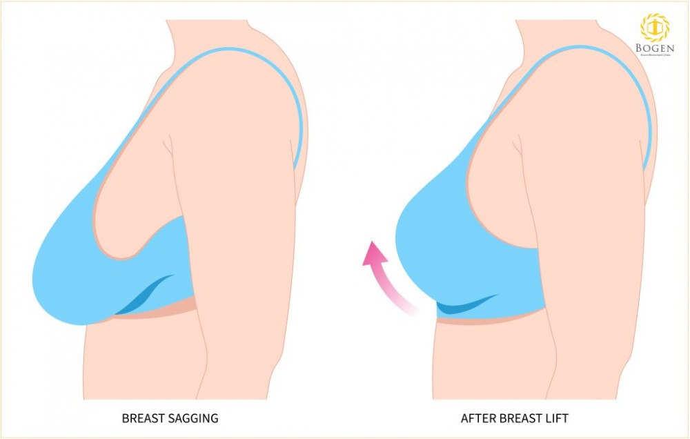 提乳手術,提乳手術是什麼,博恩妍
