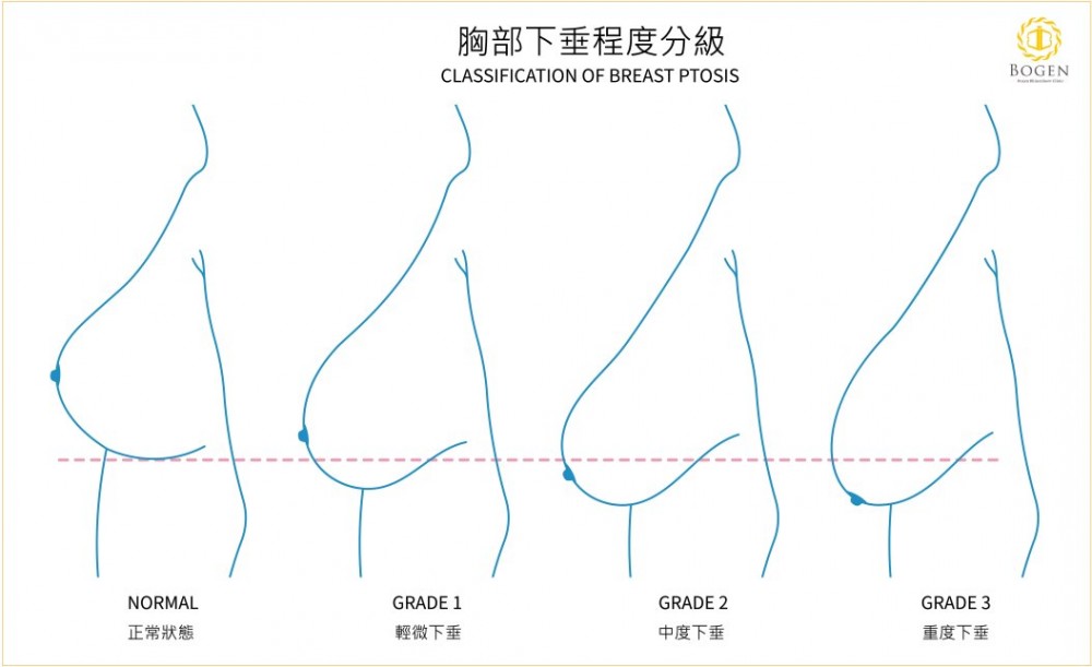 胸部下垂分級,乳房下垂分類,博恩妍