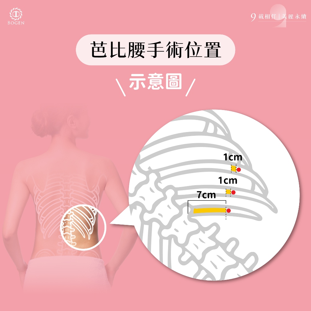 芭比腰手術位置示意圖,芭比腰手術,博恩妍