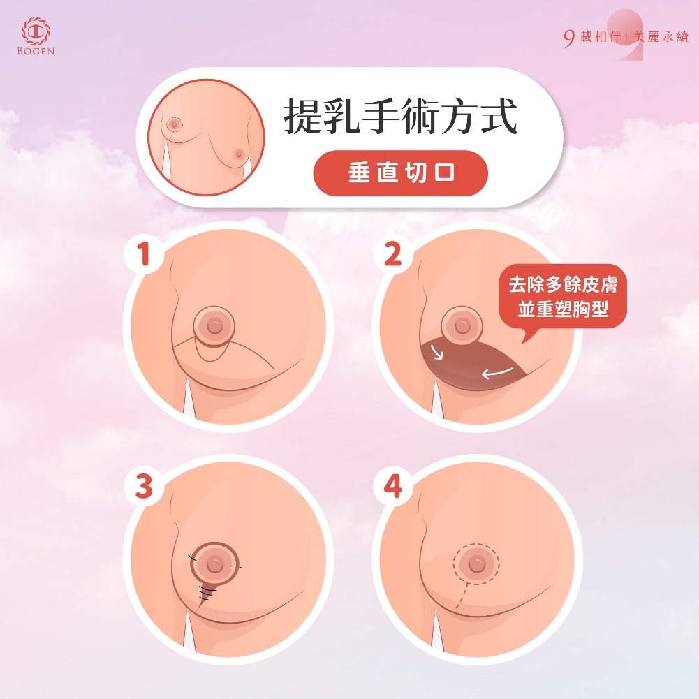 提乳手術,垂直切口,博恩妍
