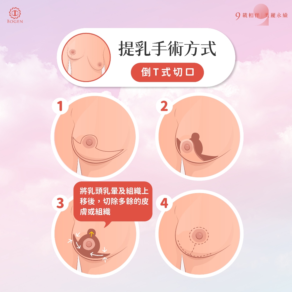 提乳手術,倒T式切口,博恩妍