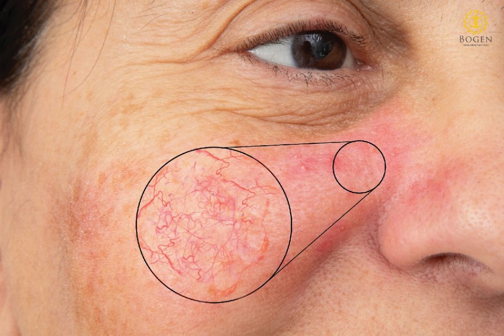 臉上血管絲, 血管絲泛紅,心動光,博恩妍