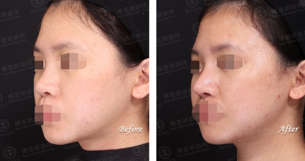 隆鼻術後口服A酸消腫更快,隆鼻與口服A酸,博恩妍