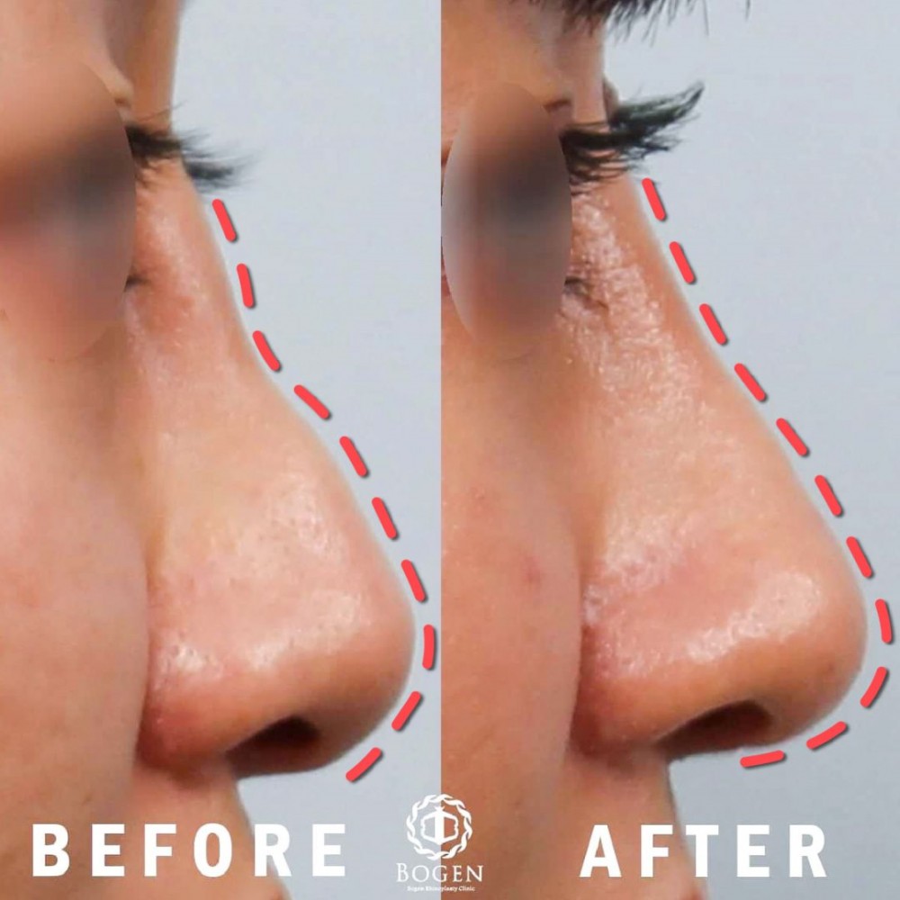 鼻樑不平整,鼻樑重修,博恩妍