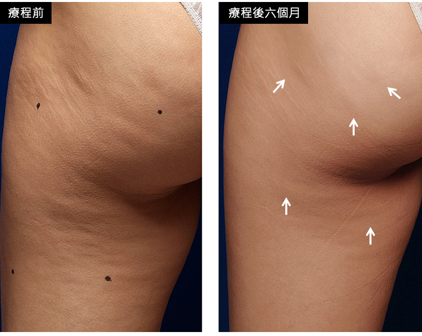鳳凰電波身體案例,鳳凰電波,博恩妍