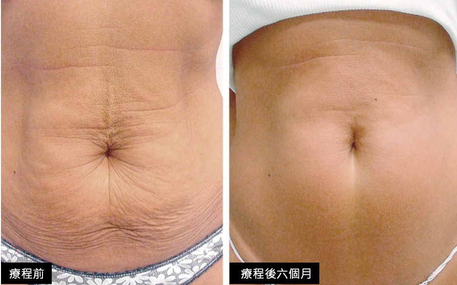 鳳凰電波身體案例,鳳凰電波,博恩妍