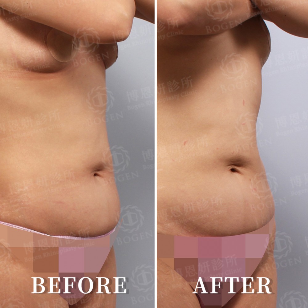 鳳凰電波治療腹部肌膚鬆弛,鳳凰電波,博恩妍