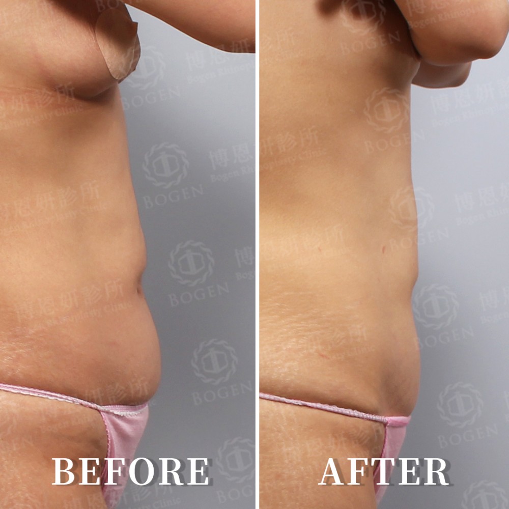 鳳凰電波治療腹部肌膚鬆弛,鳳凰電波,博恩妍