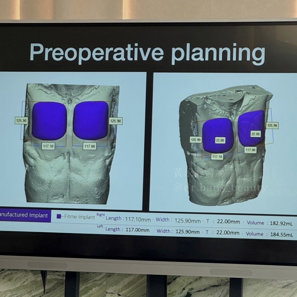 FITME完形美男性胸肌植入手術