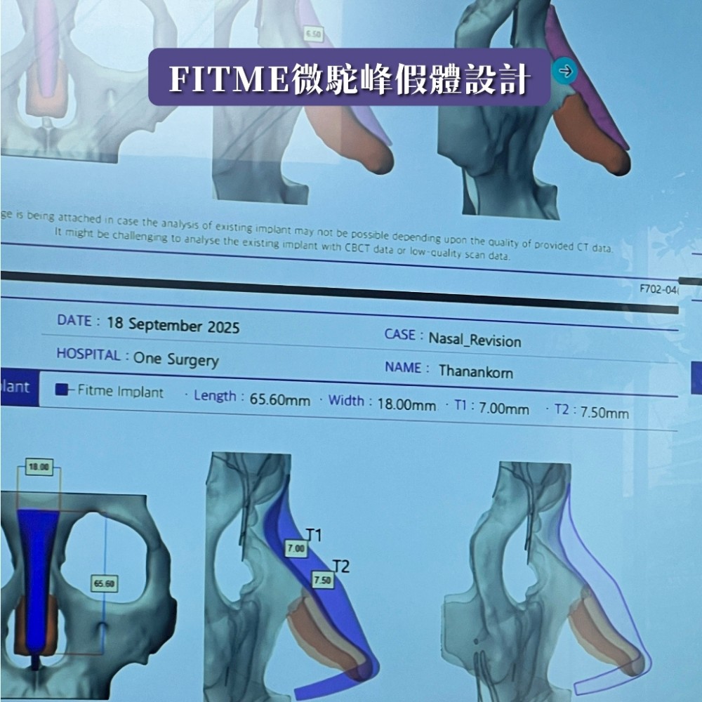 FITME完形美客製化鼻模,張簡仕煌醫師,博恩妍