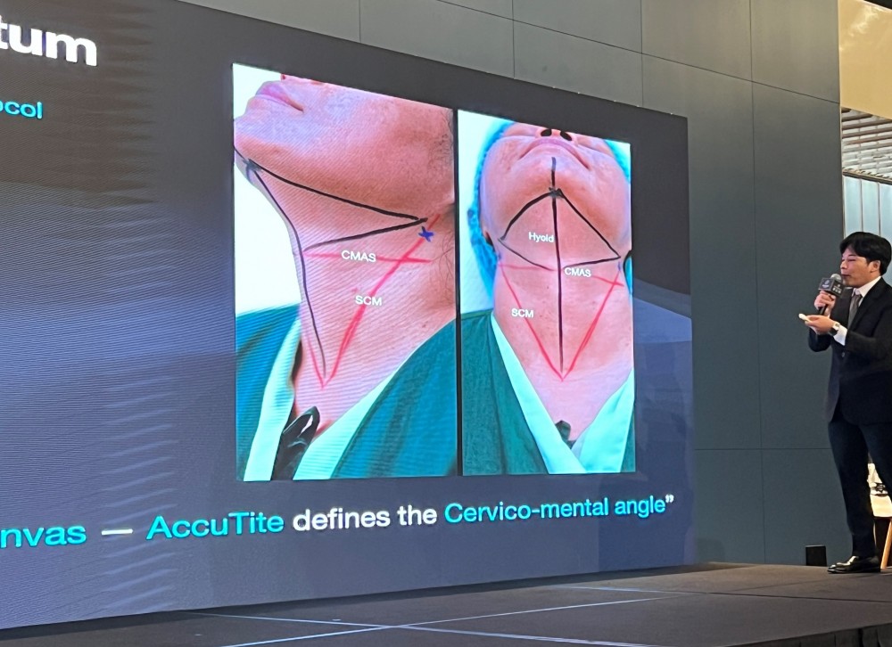 鈦特離子夾臉部緊緻臨床分享,鈦特離子夾