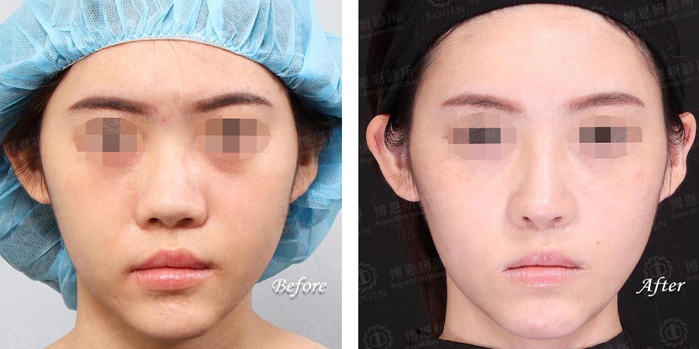 山根低使用fitme完形美隆鼻改善,博恩妍