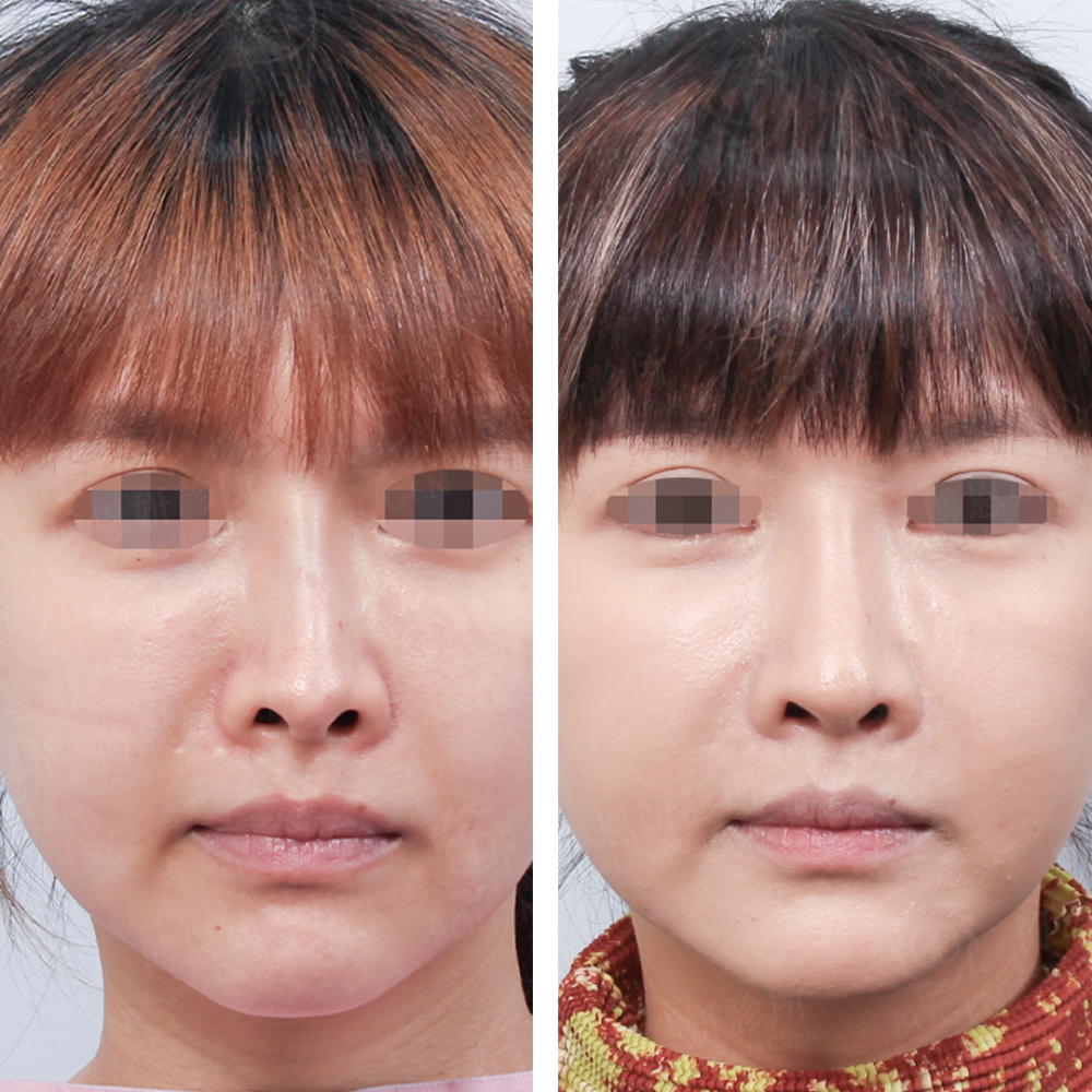 隆鼻棍感,鼻重修,博恩妍