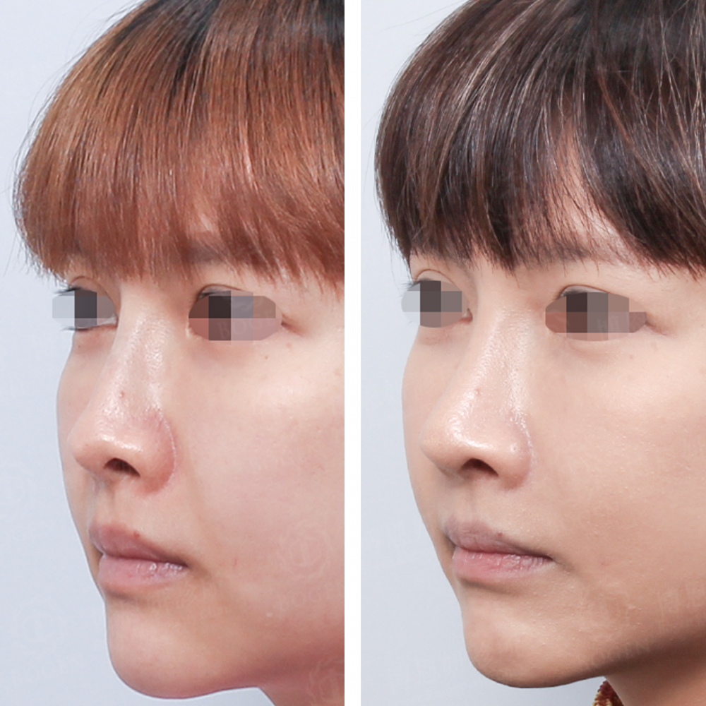 隆鼻棍感,鼻重修,博恩妍