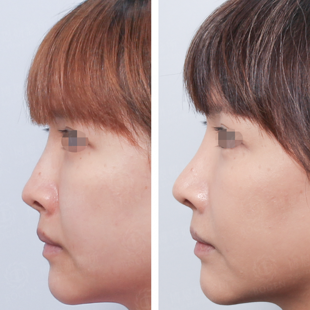 隆鼻棍感,鼻重修,博恩妍