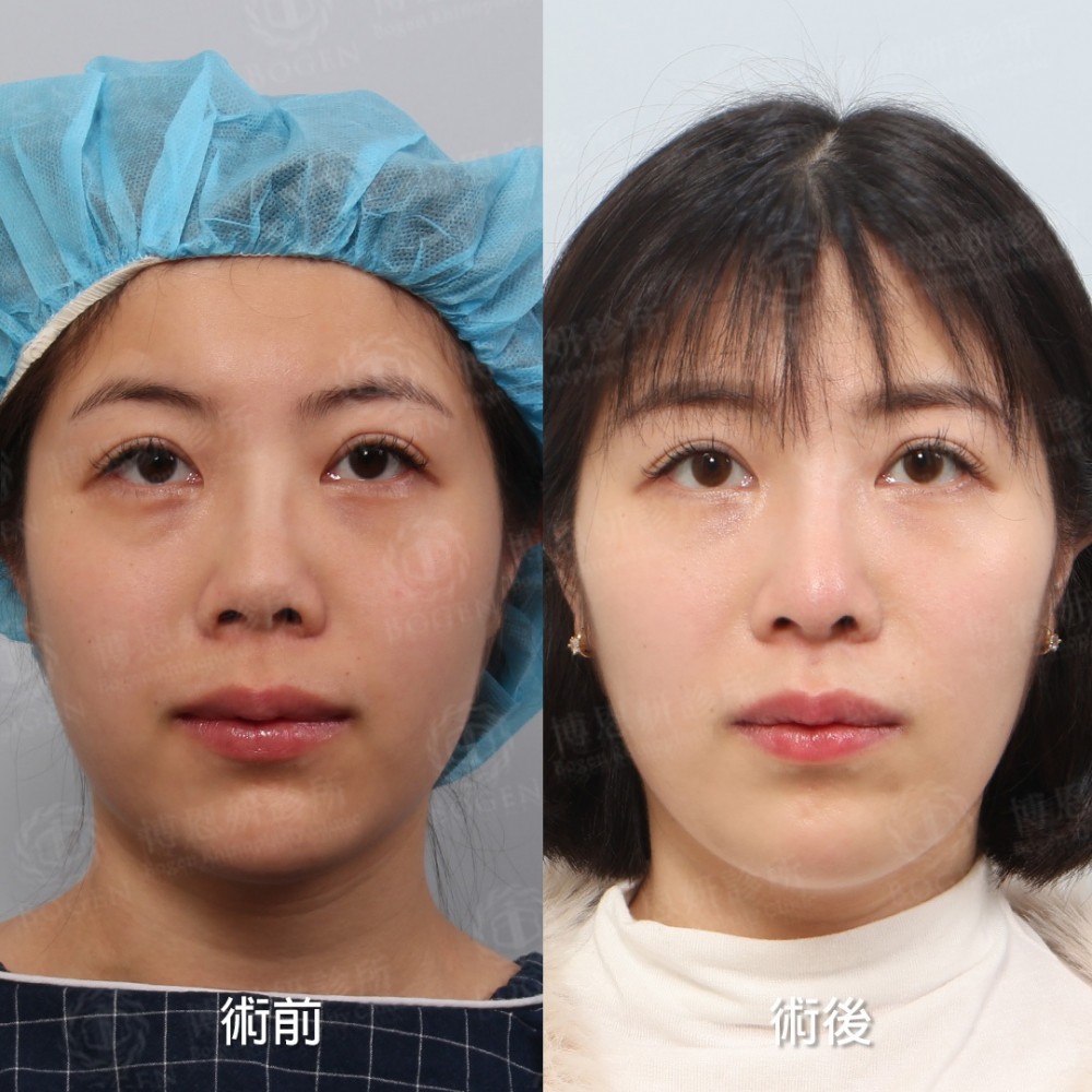 朝天鼻,朝天鼻手術,朝天鼻手術案例,博恩妍