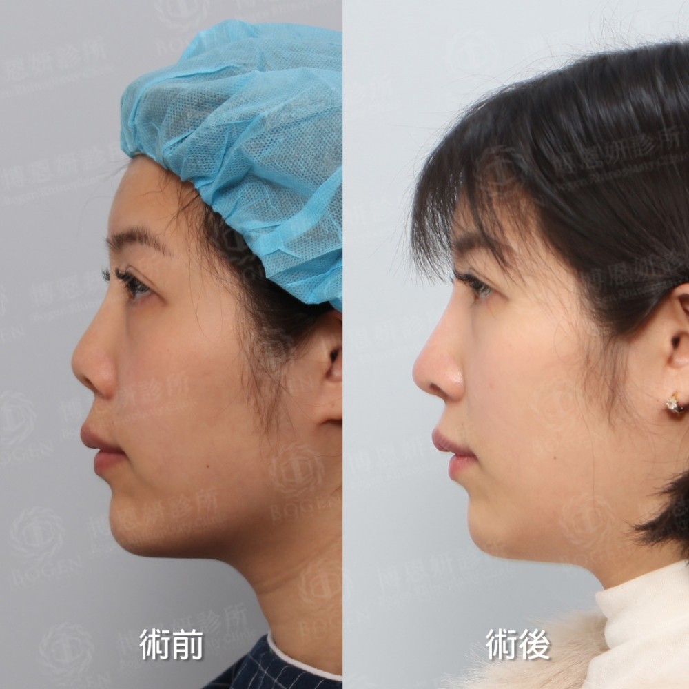 朝天鼻,朝天鼻手術,朝天鼻手術案例,博恩妍